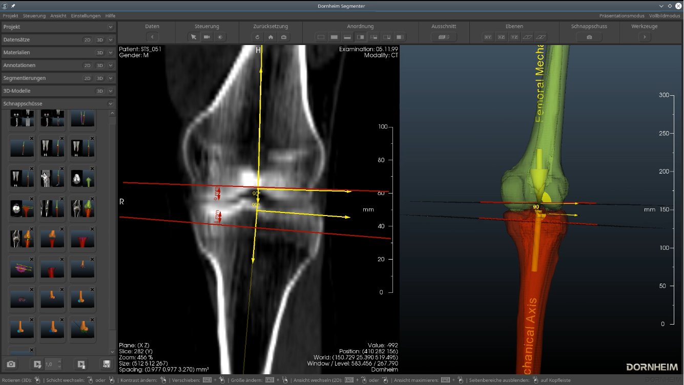OptiKneeBM – Softwarebasiertes Expertensystem für individuelles Schablonendesign bei Knieimplantaten