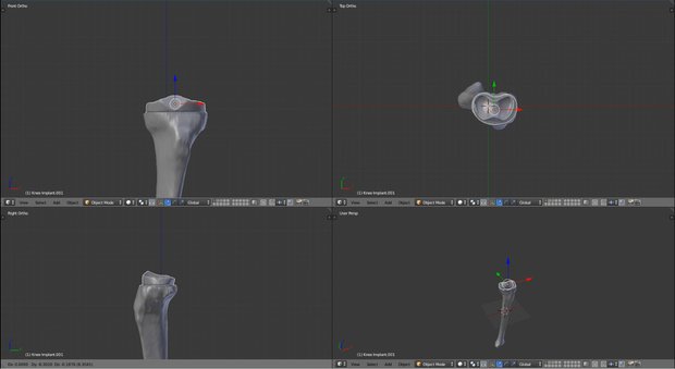 Prototypische Positionierung eines Knieimplantats am 3D-Knochenmodell